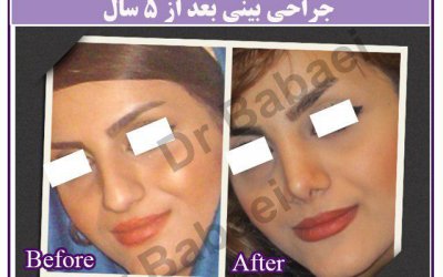 کوچک کردن پره های بینی با جراحی