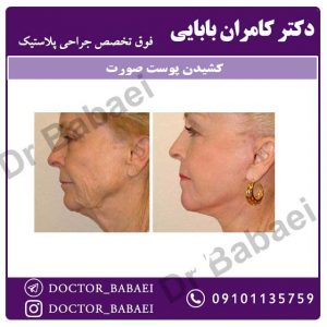 کشیدن پوست صورت