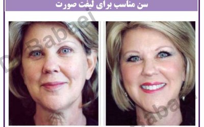 بهترین سن جراحی لیفت صورت