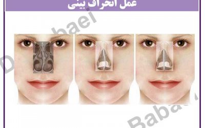 جراحی انحراف بینی در اصفهان