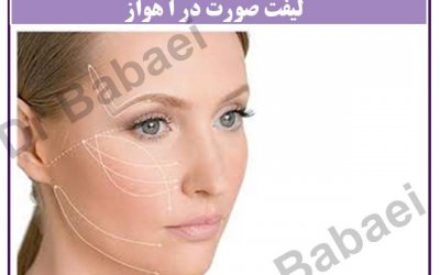 لیفت صورت در اهواز