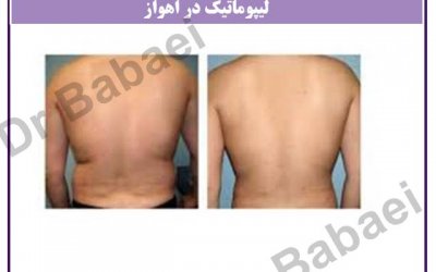 لیپوماتیک در اهواز