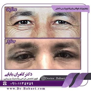 افتادگی پلک در اهواز