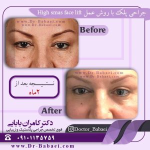 جراحی زیبایی پلک