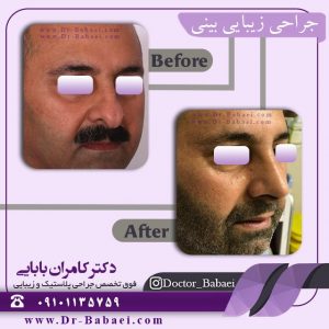 سن مناسب جراحی بینی