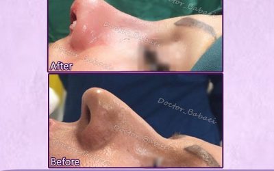 هزینه جراحی بینی در اصفهان