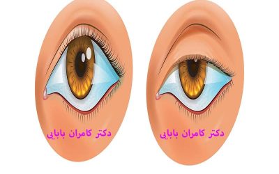 افتادگی پلک مادرزادی
