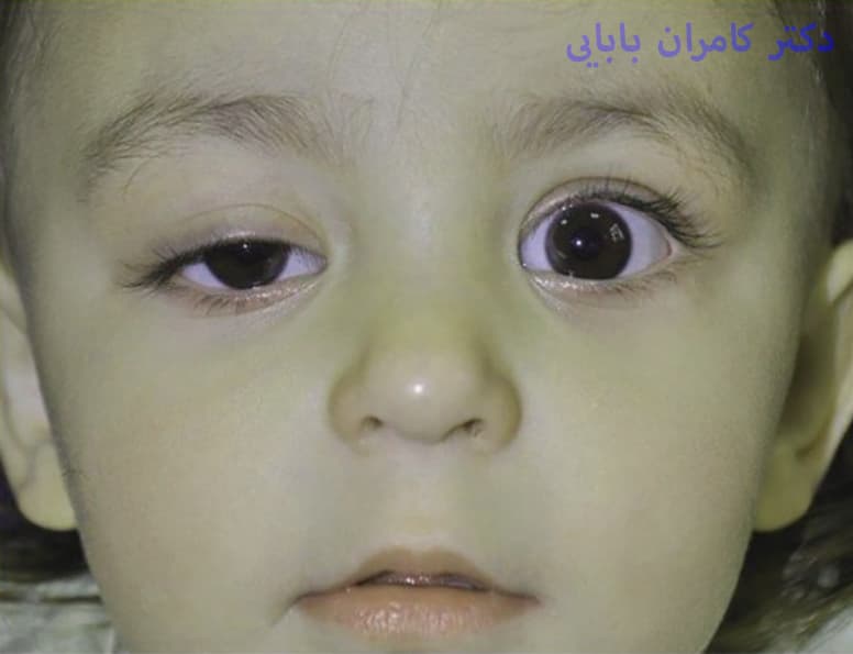 نمونه افتادگی پلک در کودکان