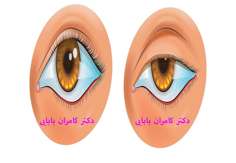 نمونه فانتزی افتادگی پلک