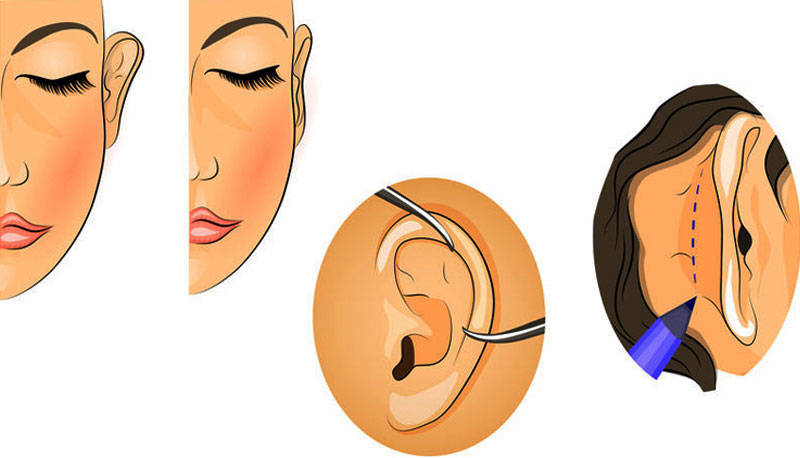 قبل-و-بعد-اتوپلاستی