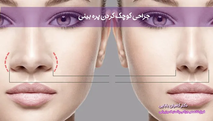 جراحی کوچک کردن پره بینی