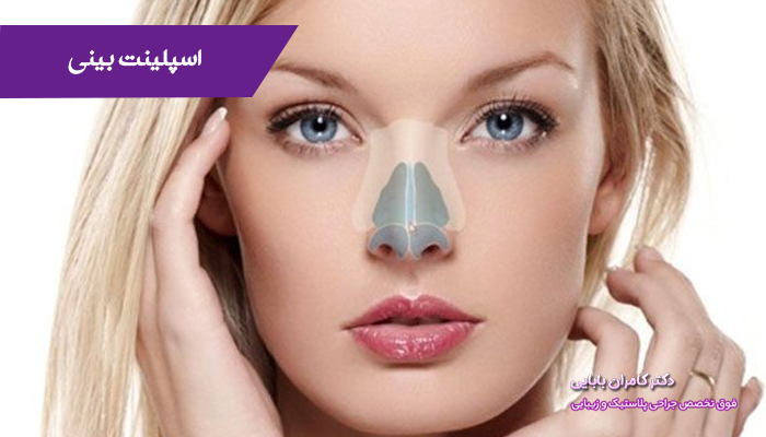 اسپلینت بینی