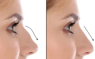 جراحی قوز بینی در اصفهان