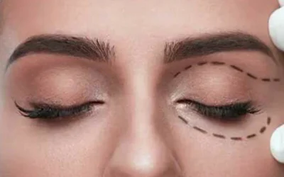 مراقبت های بعد از جراحی پلک (بلفاروپلاستی)