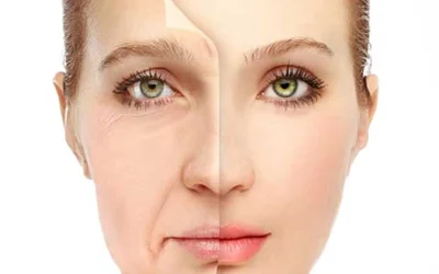 ماندگاری جراحی لیفت صورت