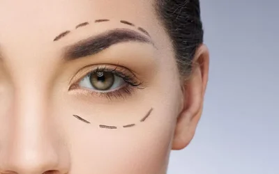 جراحی بلفاروپلاستی در اصفهان